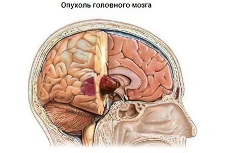 Опухоль головного мозга Опухоль головного мозга