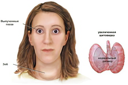 Осложнения диффузного токсического зоба