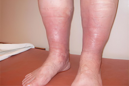 Осложнения тромбов в ноге
