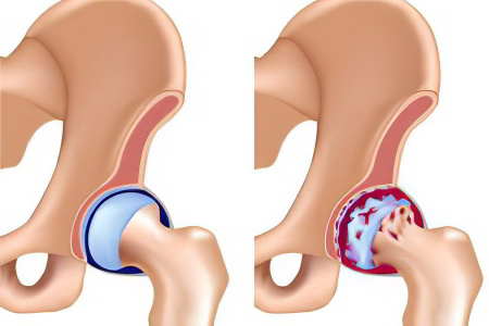 Изображение - Остеоартроз тазобедренного сустава 1 степени osteoarteoz-tazobedernogo-systava-2-stepen67