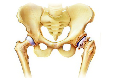 Изображение - Остеоартроз тазобедренных и коленных суставов osteoarteoz-tazobedernogo67