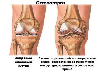 Остеоартроз Остеоартроз
