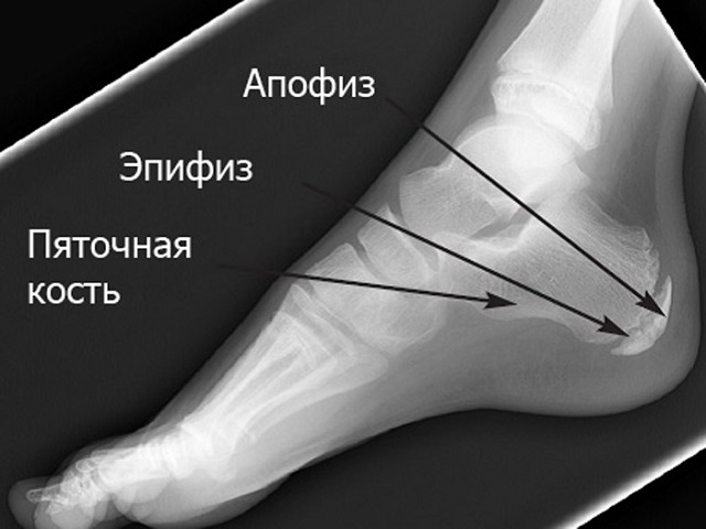 Остеохондропатия пяточного бугра