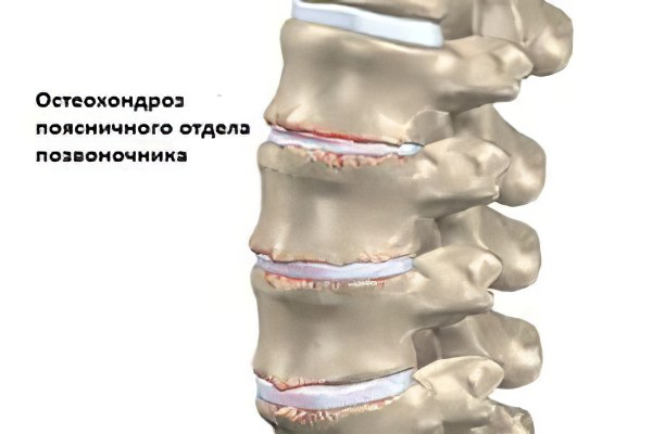 Степени остеохондроза поясничного отдела