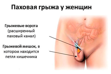 Паховая грыжа Паховая грыжа