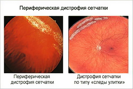 периферическая дистрофия