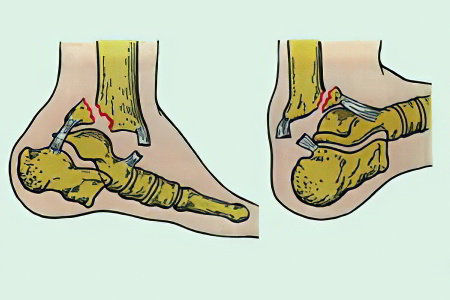 Перелом голеностопного сустава