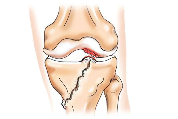 Изображение - Перелом в области коленного сустава perelom-kolenogo-sustava-879