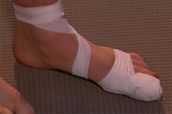 Лечение перелома пальца на ноге