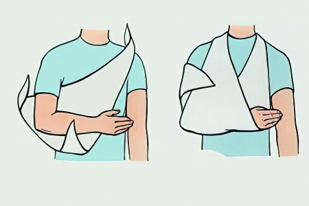 Иммобилизация при переломе плечевой кости