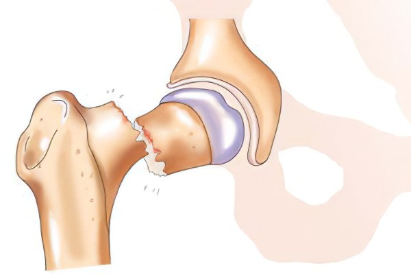Перелом тазобедренного сустава
