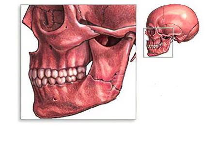перелом челюсти