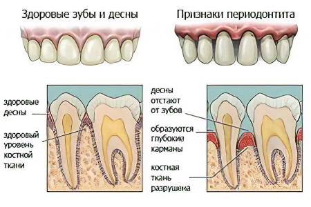 Периодонтит Периодонтит