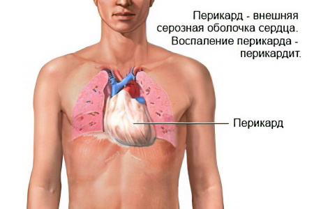 Перикардит