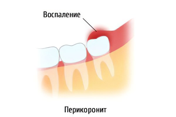 Перикоронарит Перикоронарит