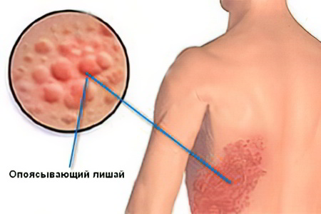 Период высыпаний