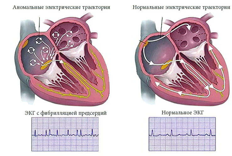 Виды мерцательной аритмии