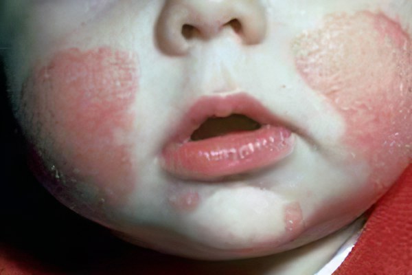 Пероральный дерматит у детей