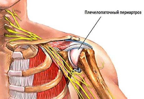 Плечелопаточный периартроз