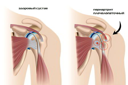 Плечелопаточный периартрит