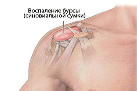 бурсит плечевого сустава