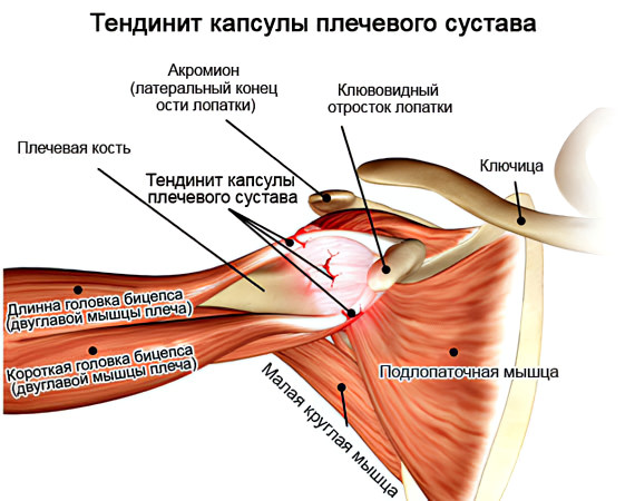Тендинит двуглавой мышцы левого плеча