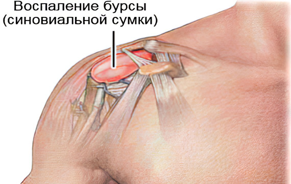 Бурсит левого плечевого сустава