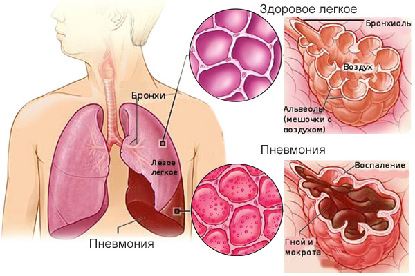 Симптомы пневмонии