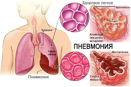 Симптомы пневмонии: как определить заболевание ещё до её начала?