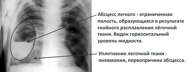 Возможные осложнения