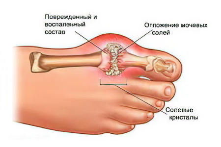 Подагра