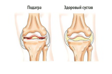 Подагра