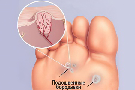 Подошвенные бородавки