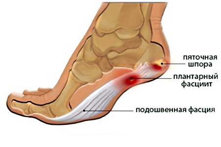 Подошвенный фасциит