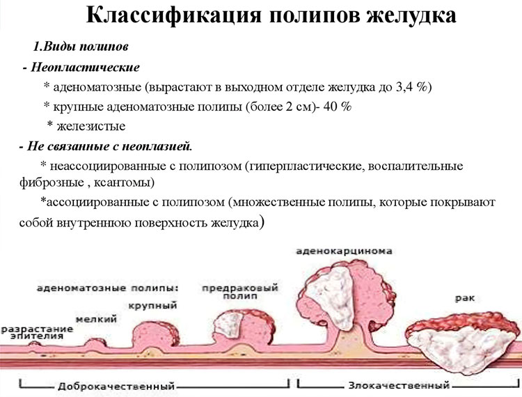 Виды полипов в желудке