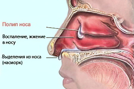 полипы