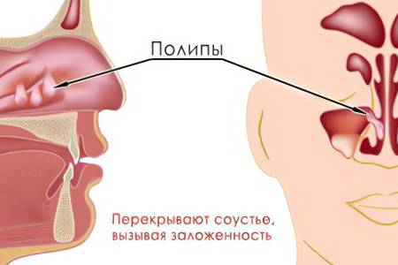 Полипозный синусит