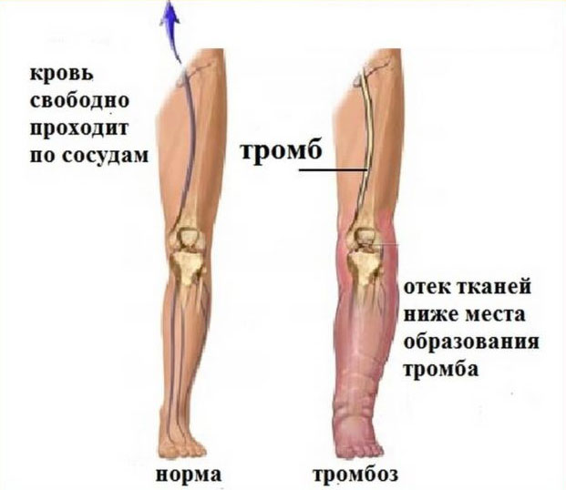 Чем характеризуется посттромбофлебитический синдром Чем характеризуется посттромбофлебитический синдром