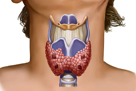 Патологии щитовидной железы
