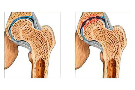 Причины артроза тазобедренного сустава