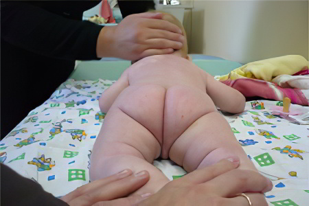 Изображение - Дисплазия тазобедренных суставов у детей старше года prichini-displazii-y-deteii346