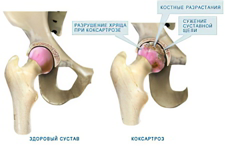 Причины коксартроза тазобедренного сустава