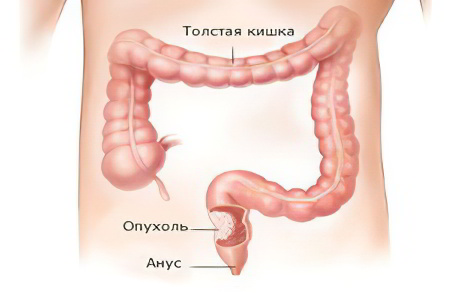 32 симптома колоректального рака