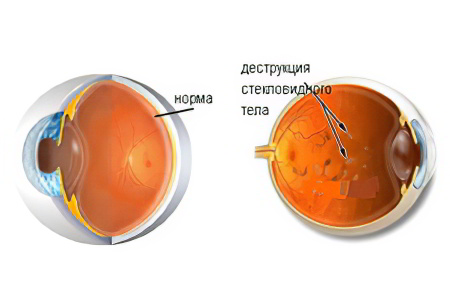Болезни стекловидного тела