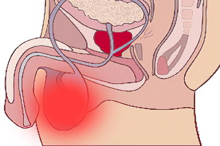 Причины возникновения боли в яичках у мужчин