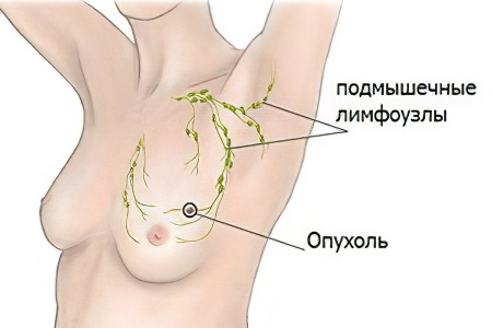 Признаки и симптомы кисты молочной железы