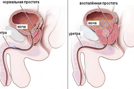 Простатит