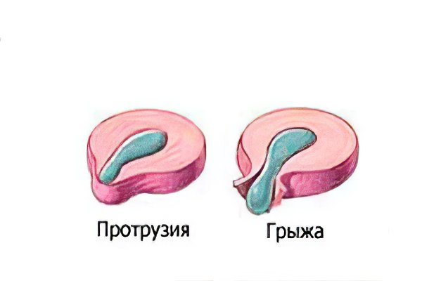 Чем протрузия отличается