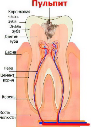 пульпит пульпит