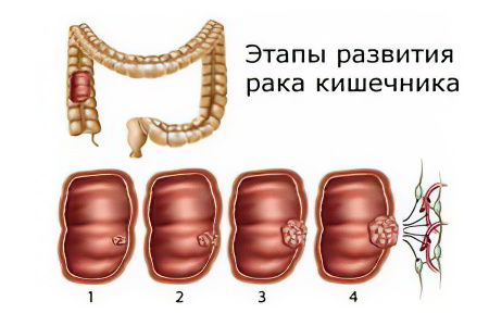 Рак кишечника